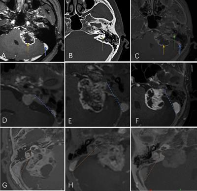 How to Precisely Open the <mark class="highlighted">Internal Auditory Canal</mark> for Resection of Vestibular Schwannoma via the Retrosigmoid Approach
